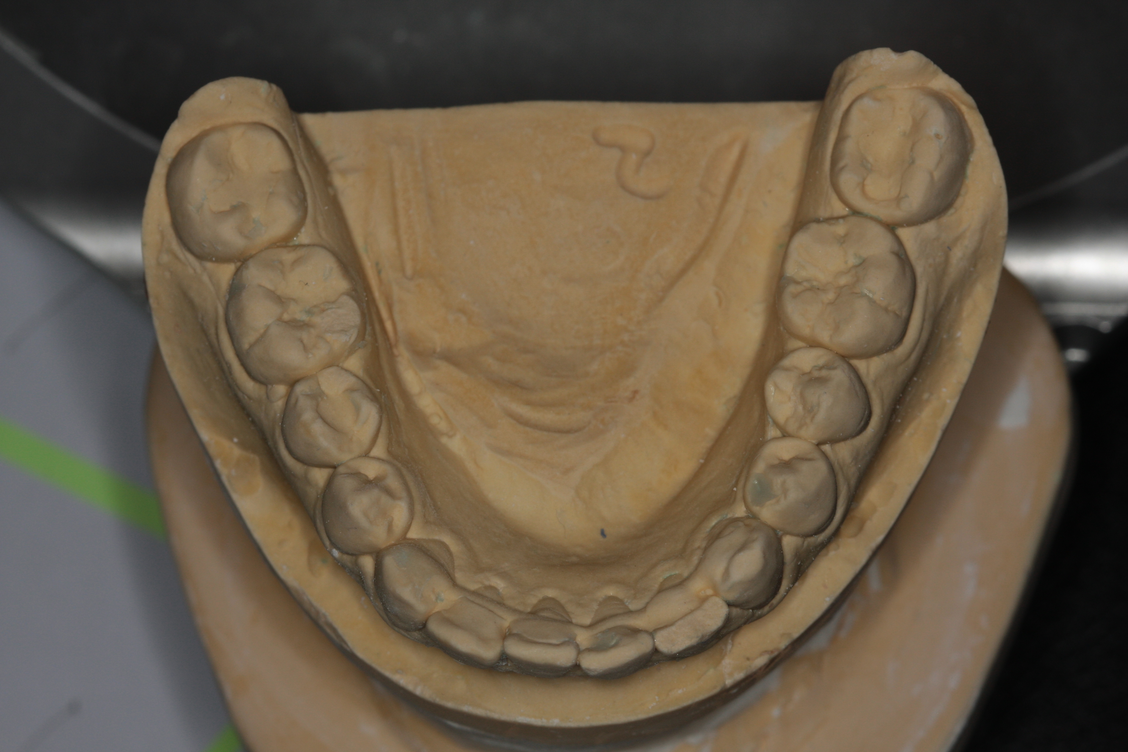Veneers